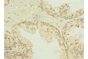 Immunohistochemistry of paraffin-embedded human prostate cancer using ABIN7170943 at dilution of 1:100 (Sulfide:quinone Oxidoreductase, Mitochondrial (SQOR) (AA 211-450) Antikörper)
