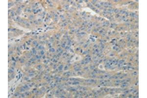 The image on the left is immunohistochemistry of paraffin-embedded Human ovarian cancer tissue using ABIN7131158(SPATA17 Antibody) at dilution 1/15, on the right is treated with fusion protein. (SPATA17 Antikörper)