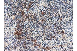 Immunohistochemical staining of paraffin-embedded Human lymphoma tissue using anti-NAPEPLD mouse monoclonal antibody. (NAPEPLD Antikörper)