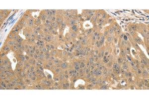 Immunohistochemistry of paraffin-embedded Human ovarian cancer using STX1A Polyclonal Antibody at dilution of 1:40 (STX1A Antikörper)