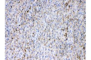 Synapsin I was detected in paraffin-embedded sections of human glioma tissues using rabbit anti- Synapsin I Antigen Affinity purified polyclonal antibody (Catalog # ) at 1 ?