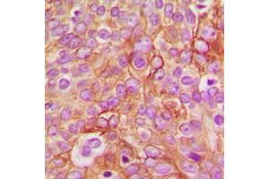 Immunohistochemical analysis of GABRB1 (pS434) staining in human breast cancer formalin fixed paraffin embedded tissue section. (GABRB1 Antikörper  (C-Term, pSer434))