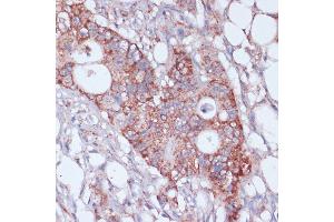 Immunohistochemistry of paraffin-embedded human colon carcinoma using MRPL23 antibody (ABIN7268564) at dilution of 1:100 (40x lens). (MRPL23 Antikörper  (AA 1-153))