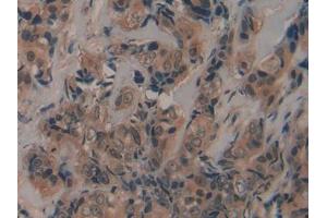 DAB staining on IHC-P; Samples: Human Breast cancer Tissue (Fibrillin 2 Antikörper  (AA 1550-1791))