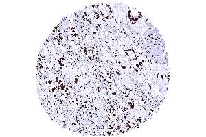 Gastric adenocarcinoma diffuse type with intense nuclear TRIM28 immunostaining of tumor cells (Rekombinanter KAP1 Antikörper  (Center))