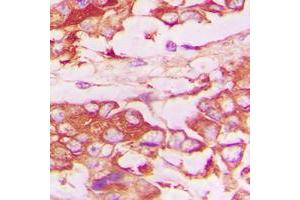 Immunohistochemical analysis of CD120b staining in human lung cancer formalin fixed paraffin embedded tissue section. (TNFRSF1B Antikörper  (C-Term))