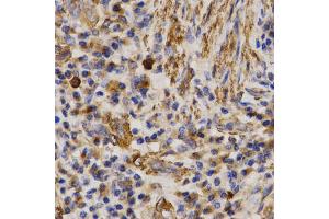 Immunohistochemistry of paraffin-embedded human lung cancer using MMP25 antibody (ABIN5971552) at dilution of 1/200 (40x lens). (MMP25 Antikörper)