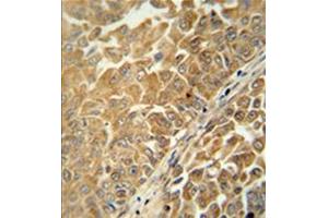 Formalin fixed, paraffin embedded human bladder carcinoma stained with C18orf25 Antibody  followed by peroxidase conjugation of the secondary antibody and DAB staining. (C18ORF25 Antikörper  (Middle Region))