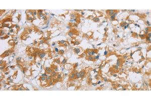 Immunohistochemistry of paraffin-embedded Human thyroid cancer using CYP2E1 Polyclonal Antibody at dilution of 1:35 (CYP2E1 Antikörper)