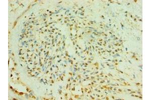 Immunohistochemistry of paraffin-embedded human breast cancer using ABIN7174009 at dilution of 1:100 (BLK Antikörper  (AA 1-280))