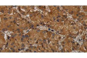 Immunohistochemistry of paraffin-embedded Human liver cancer tissue using MAS1 Polyclonal Antibody at dilution 1:50 (MAS1 Antikörper)