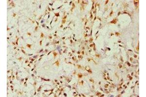 Immunohistochemistry of paraffin-embedded human breast cancer using ABIN7143676 at dilution of 1:100 (ALDH1B1 Antikörper  (AA 278-517))