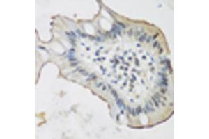 Immunohistochemistry of paraffin-embedded human stomach cancer using ALOX15 antibody (ABIN5975430) at dilution of 1/200 (40x lens). (ALOX15 Antikörper)
