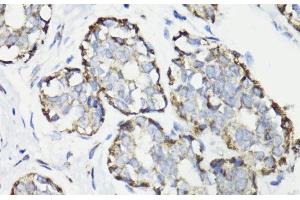 Immunohistochemistry of paraffin-embedded Human breast cancer using WASF3 Polyclonal Antibody at dilution of 1:100 (40x lens).