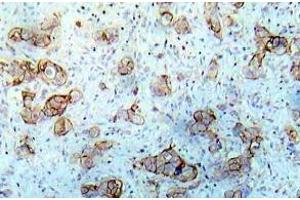Immunohistochemistry (IHC) analyzes of EGFR pAb in paraffin-embedded human breast carcinoma tissue. (EGFR Antikörper)