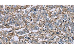 Immunohistochemistry of paraffin-embedded Human liver cancer using CD32 Polyclonal Antibody at dilution of 1:40 (Fc gamma RII (CD32) Antikörper)