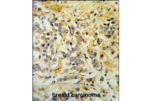 LMBR1L Antibody IHC analysis in formalin fixed and paraffin embedded breast carcinoma followed by peroxidase conjugation of the secondary antibody and DAB staining. (LMBR1L Antikörper  (C-Term))