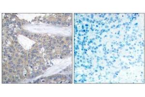 Immunohistochemical analysis of paraffin-embedded human breast carcinoma tissue using Paxillin (Ab-31) antibody (E021199). (Paxillin Antikörper)