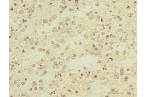 Immunohistochemistry of paraffin-embedded human glioma using ABIN7143097 at dilution of 1:100 (ARPC5 Antikörper  (AA 1-154))