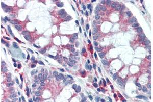 Human Colon (formalin-fixed, paraffin-embedded) stained with NPC1 antibody ABIN462125 followed by biotinylated anti-mouse IgG secondary antibody ABIN481714, alkaline phosphatase-streptavidin and chromogen. (NPC1 Antikörper)