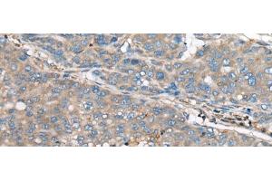 Immunohistochemistry of paraffin-embedded Human liver cancer tissue using GULP1 Polyclonal Antibody at dilution of 1:65(x200)