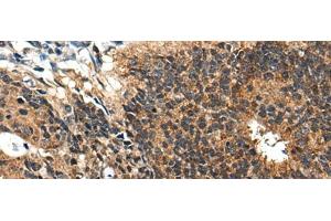 Immunohistochemistry of paraffin-embedded Human colorectal cancer tissue using BMPER Polyclonal Antibody at dilution of 1:40(x200) (BMPER Antikörper)