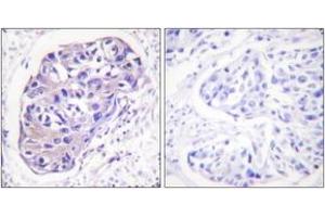Immunohistochemistry analysis of paraffin-embedded human breast carcinoma tissue, using GRK2 (Ab-29) Antibody. (GRK2 Antikörper  (AA 14-63))