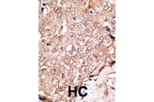 Formalin-fixed and paraffin-embedded human hepatocellular carcinoma tissue reacted with AOF2 polyclonal antibody , which was peroxidase-conjugated to the secondary antibody, followed by DAB staining.