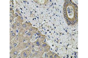 Immunohistochemistry of paraffin-embedded Human liver damage using KCNK9 Polyclonal Antibody at dilution of 1:100 (40x lens). (KCNK9 Antikörper)