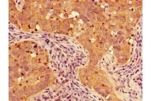 Immunohistochemistry of paraffin-embedded human pancreatic cancer using ABIN7153207 at dilution of 1:100 (TIGAR Antikörper  (AA 24-188))