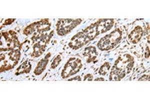 Immunohistochemistry of paraffin-embedded Human esophagus cancer tissue using CNPY2 Polyclonal Antibody at dilution of 1:25(x200)
