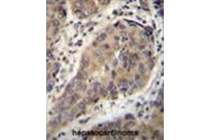 WTIP Antibody (C-term) immunohistochemistry analysis in formalin fixed and paraffin embedded human hepatocarcinoma followed by peroxidase conjugation of the secondary antibody and DAB staining.