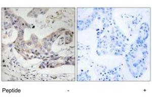 Immunohistochemistry analysis of paraffin-embedded human breast carcinoma tissue, using ALDH3B1 polyclonal antibody . (ALDH3B1 Antikörper)