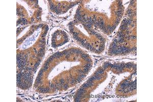 Immunohistochemistry of Human cervical cancer using SPATA7 Polyclonal Antibody at dilution of 1:30 (SPATA7 Antikörper)