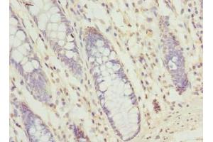 Immunohistochemistry of paraffin-embedded human colon cancer using ABIN7166217 at dilution of 1:100