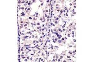 Paraformaldehyde-fixed, paraffin embedded human breast carcinoma, Antigen retrieval by boiling in sodium citrate buffer (pH6. (CDK4 Antikörper)