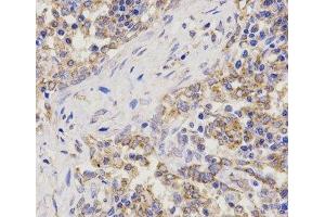 Immunohistochemistry of paraffin-embedded Human lung cancer using TNFRSF1B Polyclonal Antibody at dilution of 1:200 (40x lens).