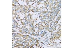 Immunohistochemistry of paraffin-embedded human liver cancer using COX6A1 antibody. (COX6A1 Antikörper  (AA 25-109))