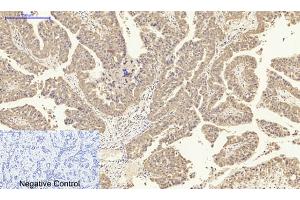 Immunohistochemical analysis of paraffin-embedded human liver cancer tissue. (IL-8 Antikörper  (C-Term))