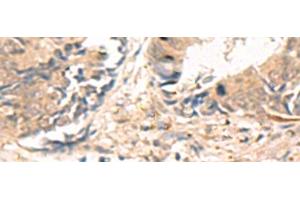 Immunohistochemistry of paraffin-embedded Human colorectal cancer tissue using ABHD2 Polyclonal Antibody at dilution of 1:40(x200) (ABHD2 Antikörper)