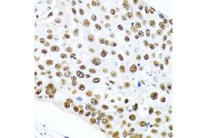 Immunohistochemistry of paraffin-embedded human lung cancer using METTL3 antibody (ABIN5974672) at dilution of 1/100 (40x lens). (METTL3 Antikörper)
