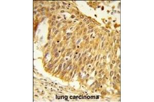 Formalin-fixed and paraffin-embedded human lung carcinoma reacted with EEFSEC Antibody (C-term), which was peroxidase-conjugated to the secondary antibody, followed by DAB staining. (EEFSEC Antikörper  (C-Term))