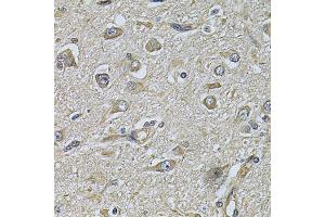 Immunohistochemistry of paraffin-embedded human brain cancer using WIPI1 Antibody. (WIPI1 Antikörper)