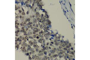 Immunohistochemistry of paraffin-embedded human lung cancer using TEAD1 antibody (ABIN6291475) at dilution of 1:100 (40x lens). (TEAD1 Antikörper)