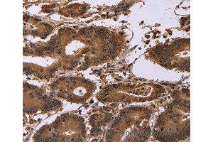Immunohistochemistry of Human colon cancer using EDN2 Polyclonal Antibody at dilution of 1:30 (Endothelin 2 Antikörper)