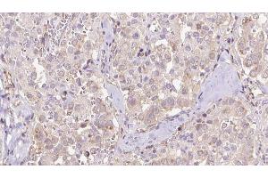 ABIN6273316 at 1/100 staining Human thyroid cancer tissue by IHC-P. (Seladin 1 Antikörper  (N-Term))
