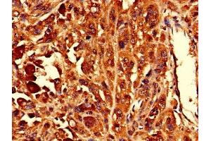 Immunohistochemistry of paraffin-embedded human melanoma using ABIN7142728 at dilution of 1:100 (RPL10L Antikörper  (AA 1-214))