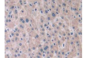 DAB staining on IHC-P; Samples: Human Liver cancer Tissue (PAFAH2 Antikörper  (AA 1-392))