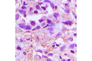 Immunohistochemical analysis of PDGFA staining in human lung cancer formalin fixed paraffin embedded tissue section. (PDGFA Antikörper  (Center))