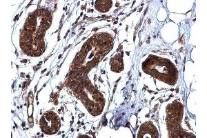 IHC-P Image ROCK1 antibody [N1N2], N-term detects ROCK1 protein at cytoplasm on human breast carcinoma by immunohistochemical analysis. (ROCK1 Antikörper  (N-Term))